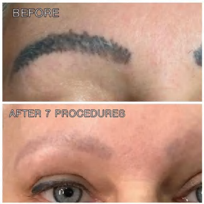 Q-Switch laser tattoo removal — photograph 1