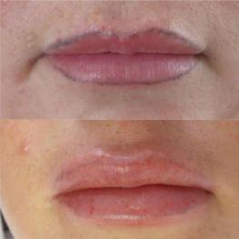 Q-Switch laser tattoo removal — photograph 2