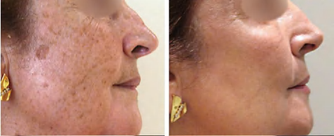 Picosecond Laser — photograph 3