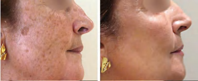Picosecond Laser — photograph 4