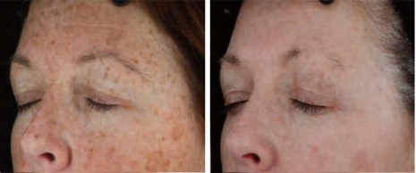 Picosecond Laser — photograph 5