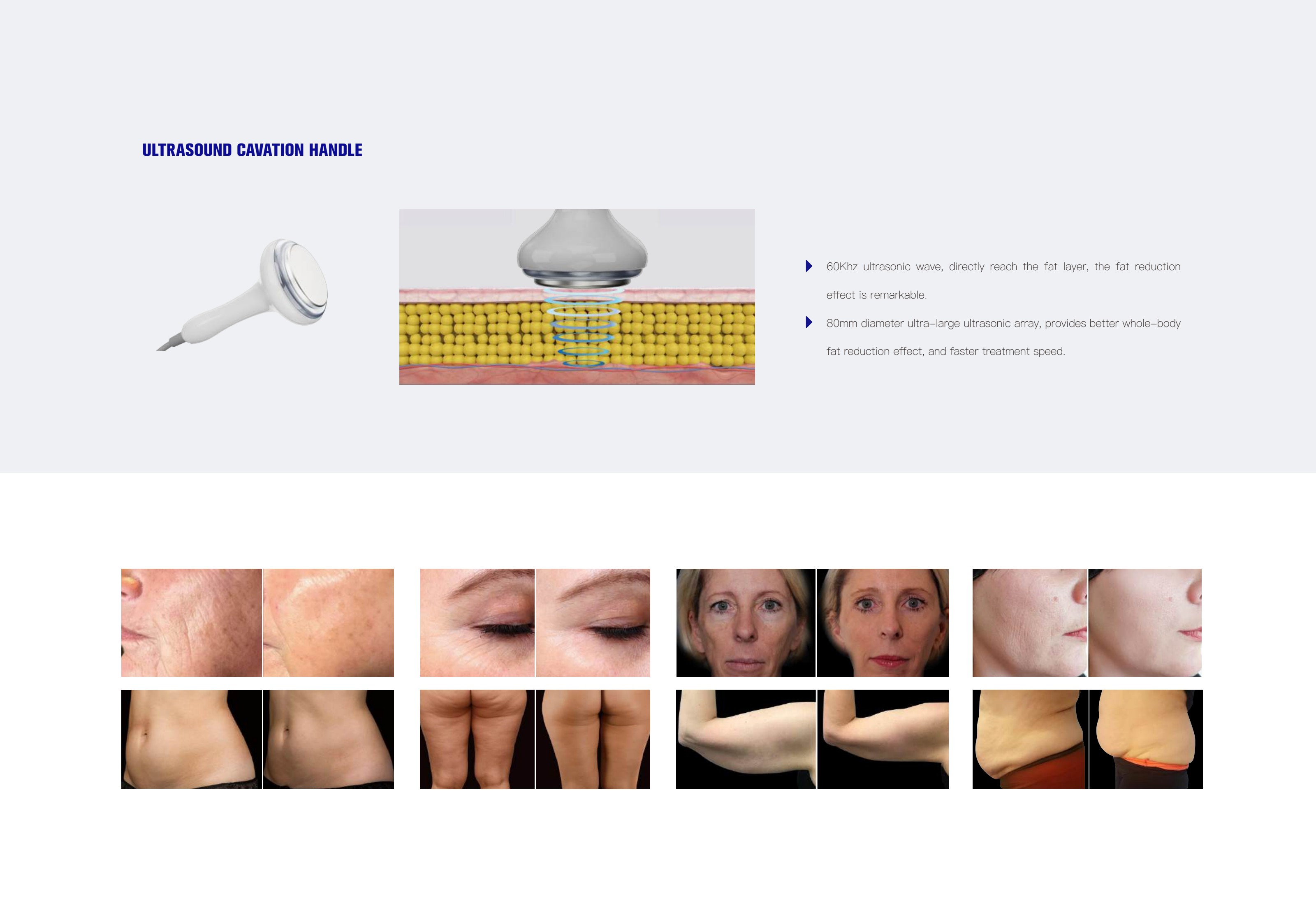 RF+Vacuum+IR+ Ultrasound Cavitation 4 in 1 — photograph 4